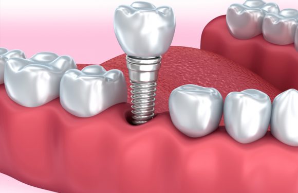 Do You Know Why A Dental Implant Can Fail?