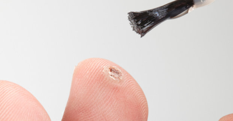 WARTROL- An Effective Solution to Your Wart Problem