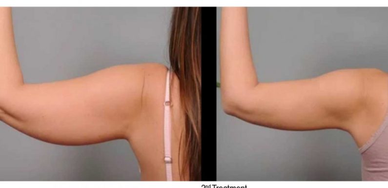 Why go for coolsculpting?
